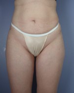 Liposuction