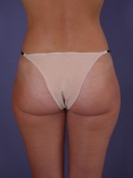 Liposuction Before and after photo