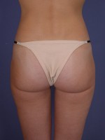 Liposuction