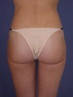 Liposuction Before and after photo