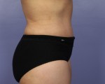 Liposuction Before and after photo