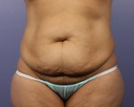 Liposuction Before and after photo