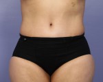 Liposuction Before and after photo