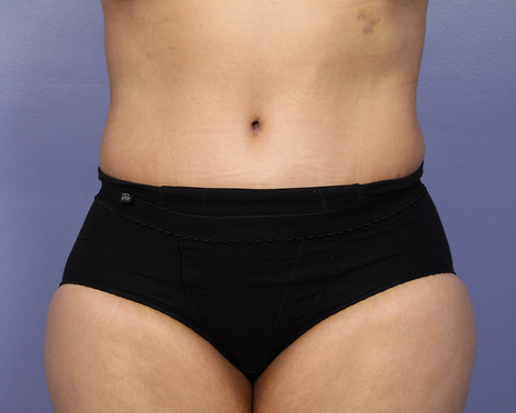 Liposuction before and after photo