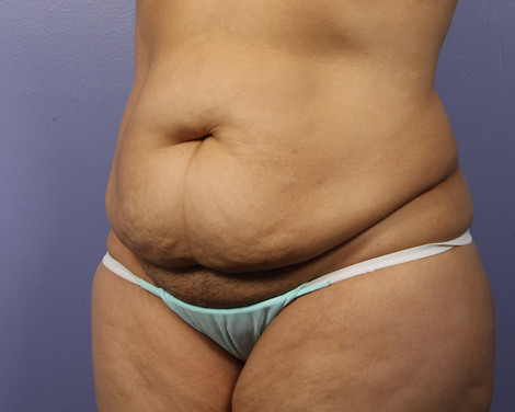 Liposuction before and after photo