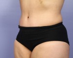 Liposuction