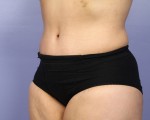 Liposuction Before and after photo