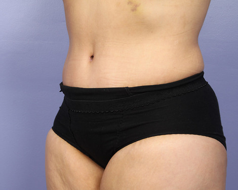 Liposuction before and after photo