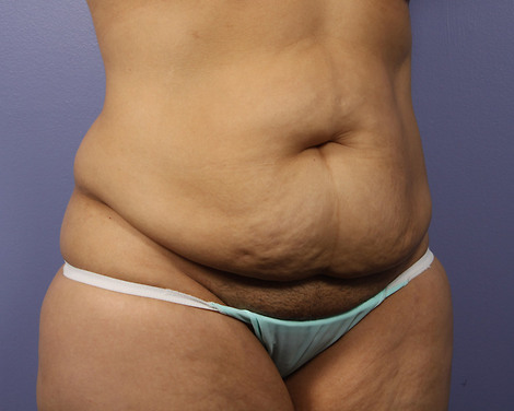 Liposuction before and after photo