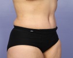 Liposuction Before and after photo