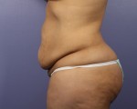 Liposuction Before and after photo