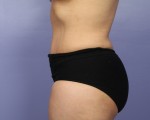 Liposuction Before and after photo