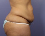 Liposuction Before and after photo