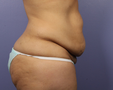 Liposuction before and after photo