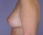 Liposuction Before and after photo