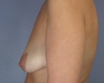 Liposuction Before and after photo