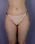 Liposuction Before and after photo