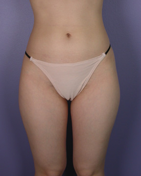 Liposuction before and after photo