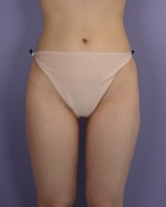Liposuction