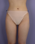 Liposuction Before and after photo