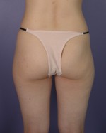 Liposuction