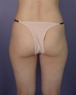 Liposuction Before and after photo