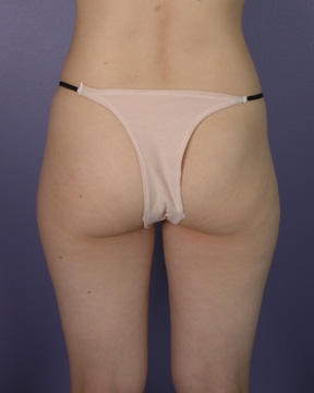 Liposuction before and after photo