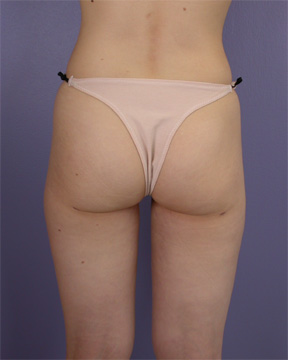 Liposuction before and after photo