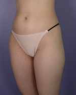 Liposuction Before and after photo