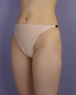 Liposuction Before and after photo