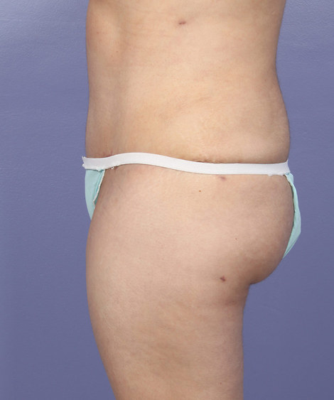 Liposuction before and after photo