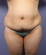 Liposuction Before and after photo