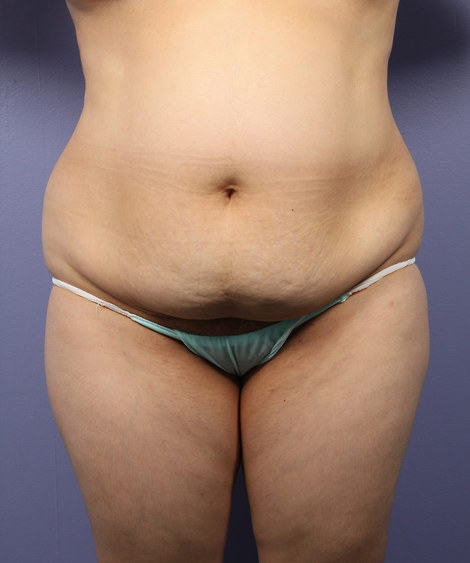 Liposuction before and after photo