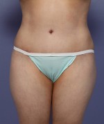 Liposuction Before and after photo