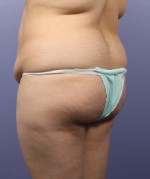 Liposuction Before and after photo