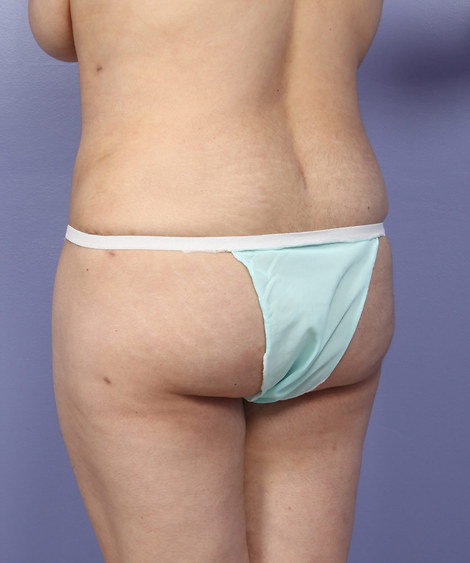 Liposuction before and after photo