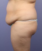 Liposuction Before and after photo