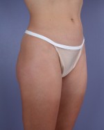 Liposuction