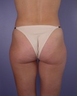 Liposuction