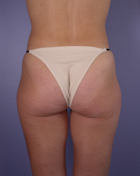 Liposuction before and after photo