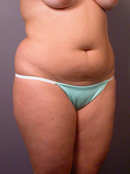 Liposuction before and after photo