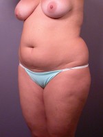 Liposuction Before and after photo