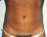 Liposuction