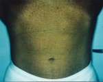 Liposuction