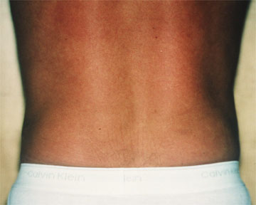 Liposuction before and after photo