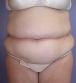 Liposuction Before and after photo