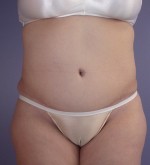 Liposuction Before and after photo