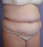 Liposuction Before and after photo