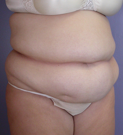 Liposuction before and after photo