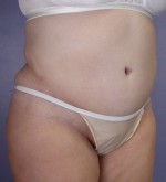 Liposuction Before and after photo